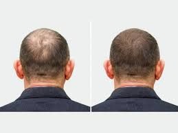 Discover the Secret to Confidence: A Complete Guide to Hair Transplant in Dubai